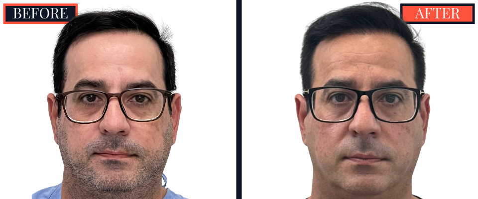 3286 Graft FUT Hair Transplant