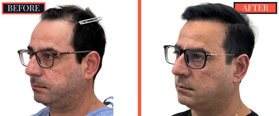 3286 Graft FUT Hair Transplant