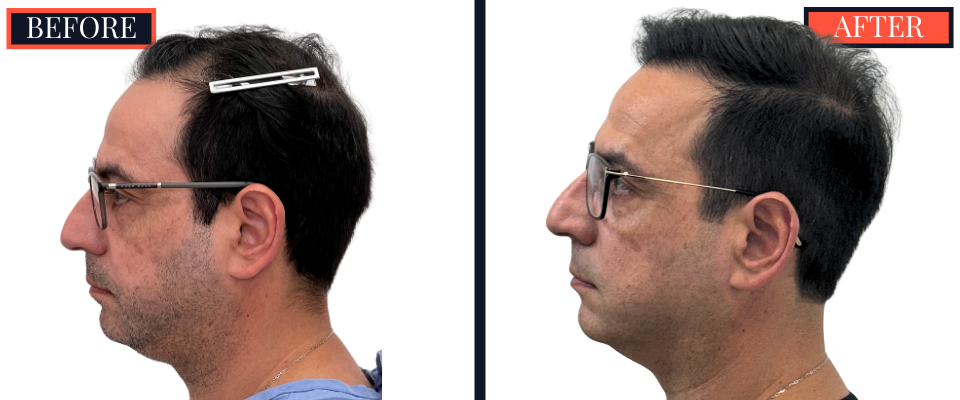 3286 Graft FUT Hair Transplant
