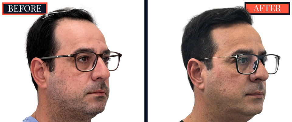 3286 Graft FUT Hair Transplant