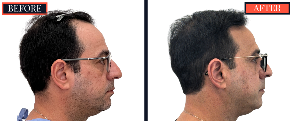 3286 Graft FUT Hair Transplant