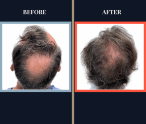 2511 GRAFT FUT HAIR TRANSPLANT