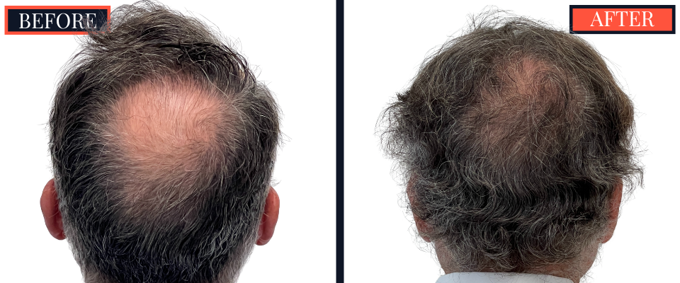 2511 GRAFT FUT HAIR TRANSPLANT