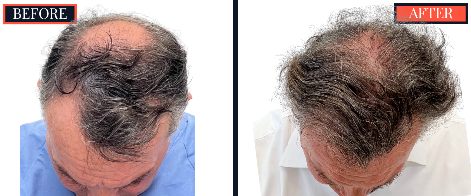 2511 GRAFT FUT HAIR TRANSPLANT