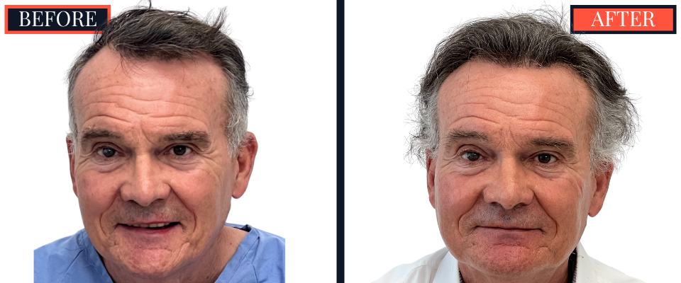 2511 GRAFT FUT HAIR TRANSPLANT