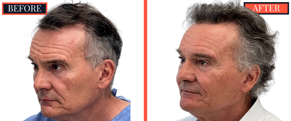 2511 GRAFT FUT HAIR TRANSPLANT