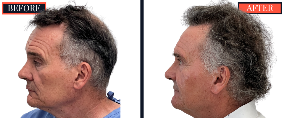 2511 GRAFT FUT HAIR TRANSPLANT