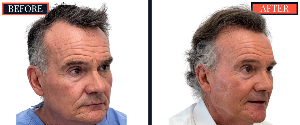 2511 GRAFT FUT HAIR TRANSPLANT