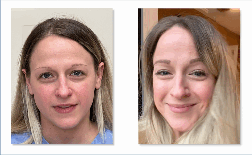 Eyebrow Transplant Before and After