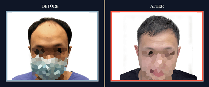 Hair Transplant Before & After Results