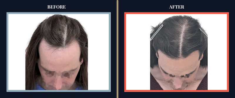 Hair Transplant Before & After Results