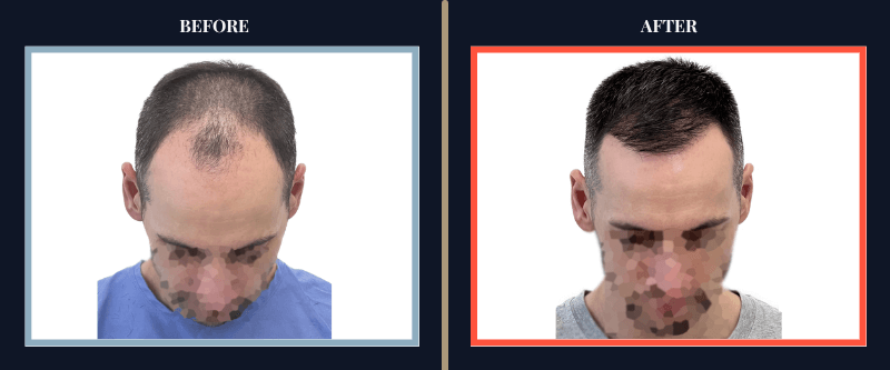 Hair Transplant Before & After Results