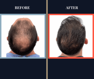 3008 GRAFT FUE HAIR TRANSPLANT BEFORE AND AFTER RESULT