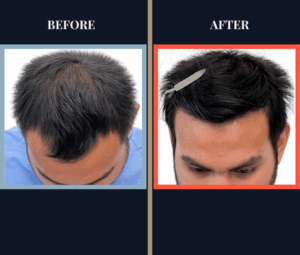 1006 GRAFT FUE HAIR TRANSPLANT - 1 YR POST-OP RESULT