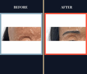 FUT EYEBROW TRANSPLANT