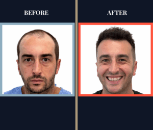 2206 graft FUE HAIR TRANSPLANT - 1 year Post-Op Results