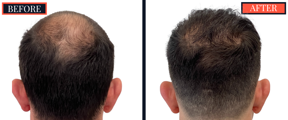 3008 GRAFT FUE HAIR TRANSPLANT BEFORE AND AFTER RESULT