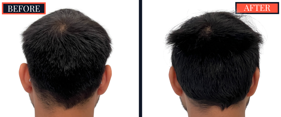 1006 GRAFT FUE HAIR TRANSPLANT - 1 YR POST-OP RESULT