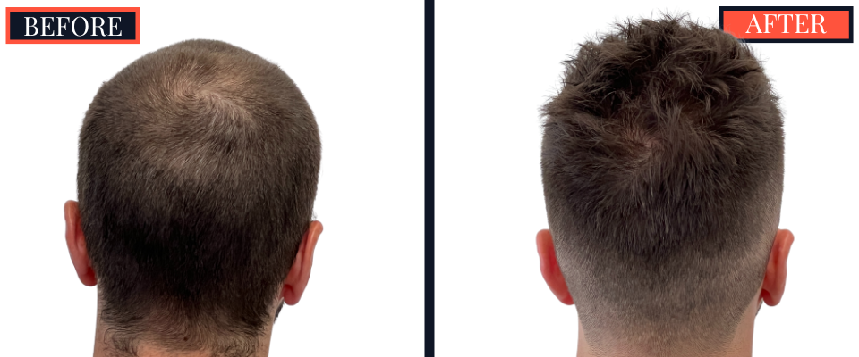 2206 graft FUE HAIR TRANSPLANT - 1 year Post-Op Results
