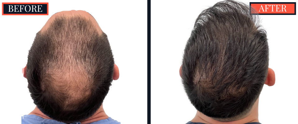 3008 GRAFT FUE HAIR TRANSPLANT BEFORE AND AFTER RESULT