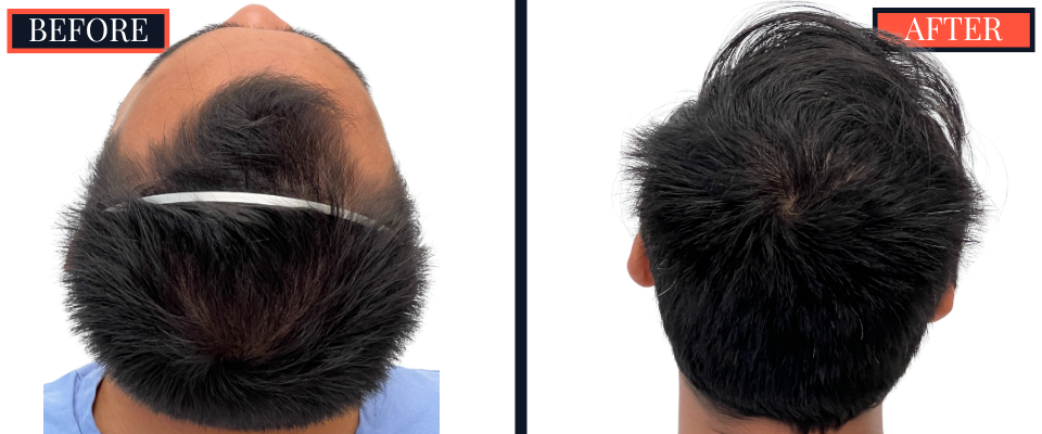 1006 GRAFT FUE HAIR TRANSPLANT - 1 YR POST-OP RESULT
