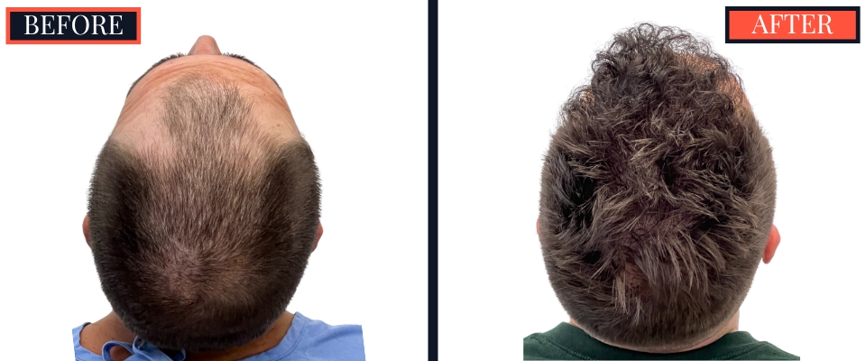2206 graft FUE HAIR TRANSPLANT - 1 year Post-Op Results