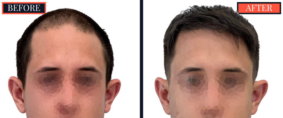 3008 GRAFT FUE HAIR TRANSPLANT BEFORE AND AFTER RESULT