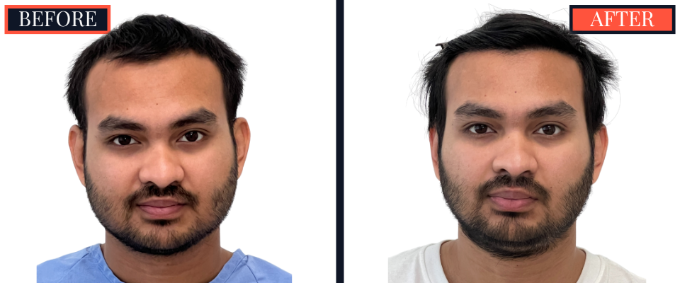 1006 GRAFT FUE HAIR TRANSPLANT - 1 YR POST-OP RESULT