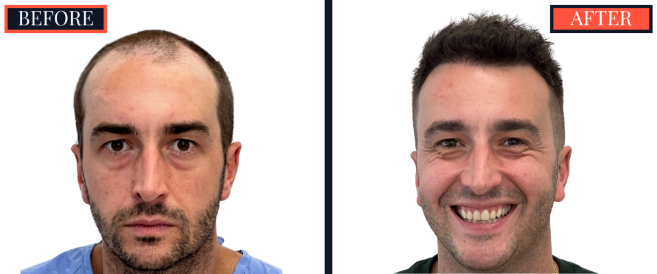 2206 graft FUE HAIR TRANSPLANT - 1 year Post-Op Results