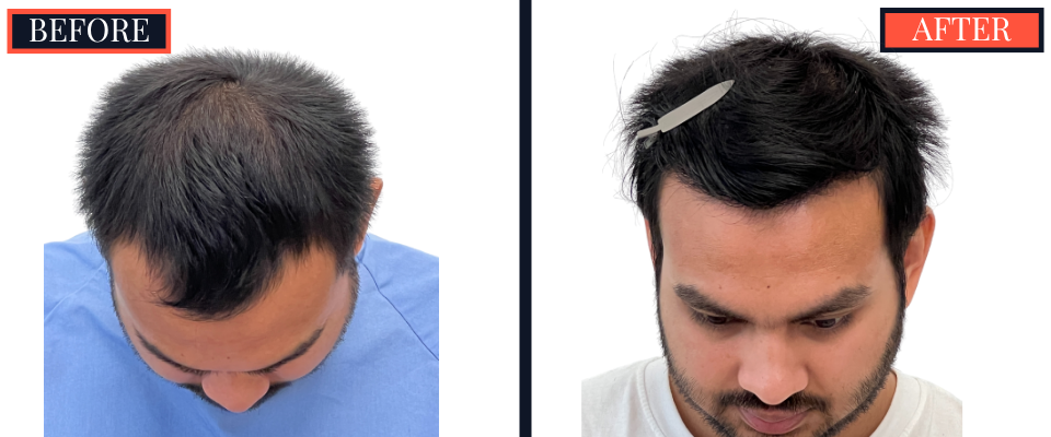 1006 GRAFT FUE HAIR TRANSPLANT - 1 YR POST-OP RESULT