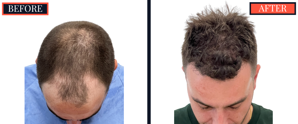 2206 graft FUE HAIR TRANSPLANT - 1 year Post-Op Results