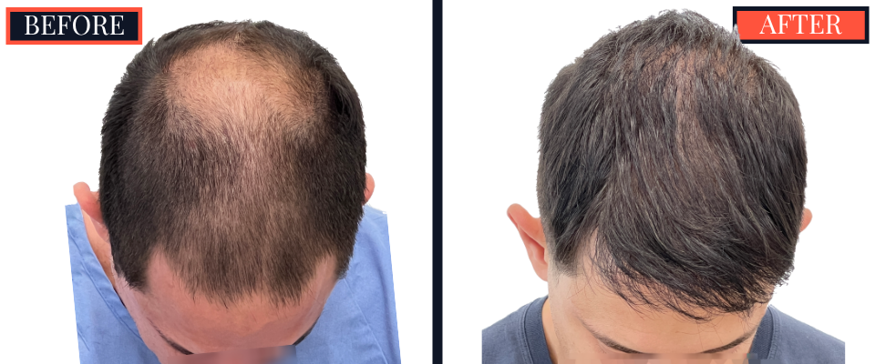 3008 GRAFT FUE HAIR TRANSPLANT BEFORE AND AFTER RESULT
