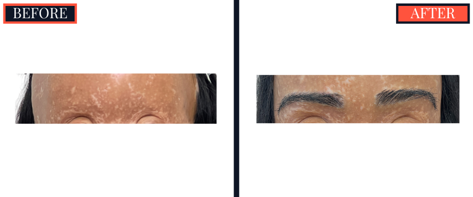 FUT EYEBROW TRANSPLANT