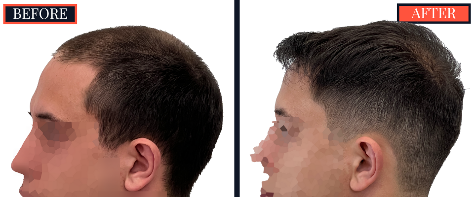 3008 GRAFT FUE HAIR TRANSPLANT BEFORE AND AFTER RESULT