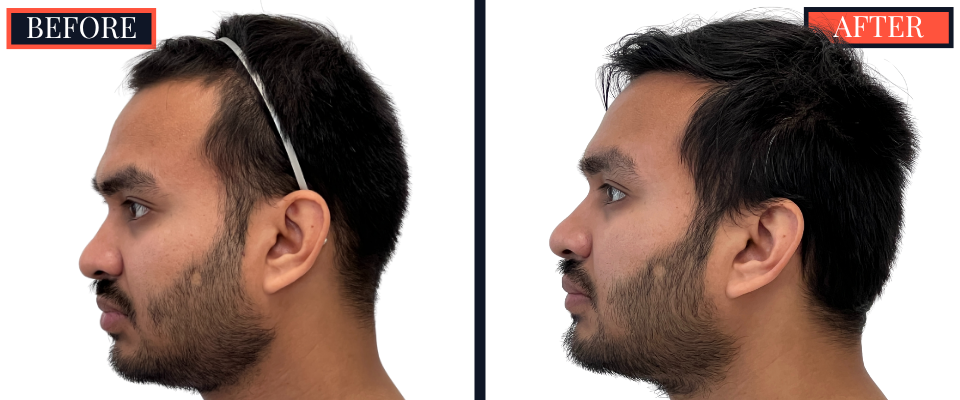 1006 GRAFT FUE HAIR TRANSPLANT - 1 YR POST-OP RESULT