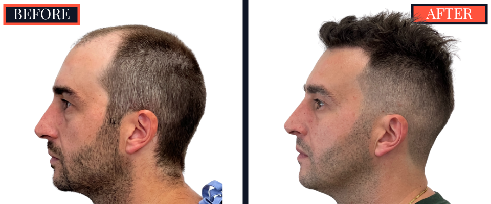 2206 graft FUE HAIR TRANSPLANT - 1 year Post-Op Results