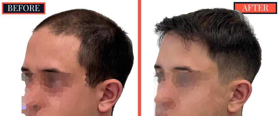 3008 GRAFT FUE HAIR TRANSPLANT BEFORE AND AFTER RESULT
