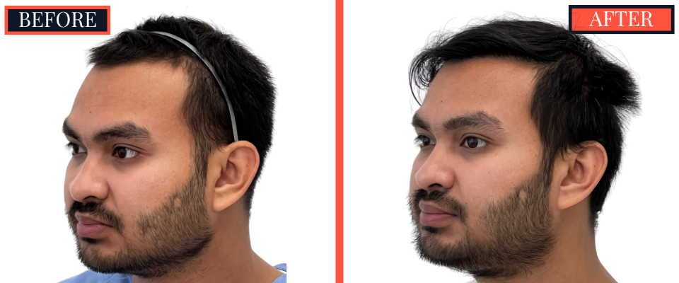 1006 GRAFT FUE HAIR TRANSPLANT - 1 YR POST-OP RESULT