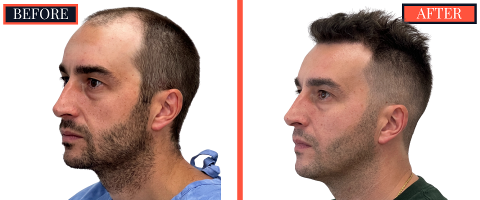 2206 graft FUE HAIR TRANSPLANT - 1 year Post-Op Results