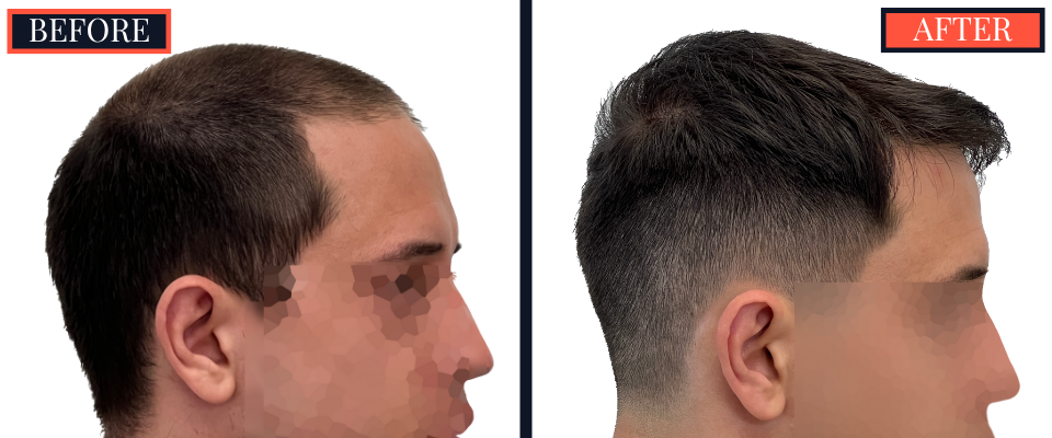 3008 GRAFT FUE HAIR TRANSPLANT BEFORE AND AFTER RESULT
