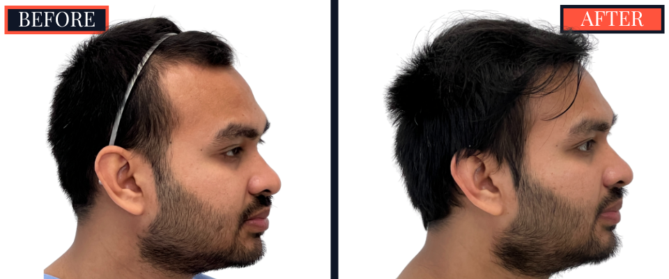 1006 GRAFT FUE HAIR TRANSPLANT - 1 YR POST-OP RESULT