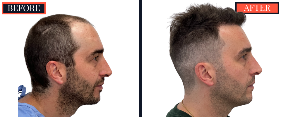 2206 graft FUE HAIR TRANSPLANT - 1 year Post-Op Results