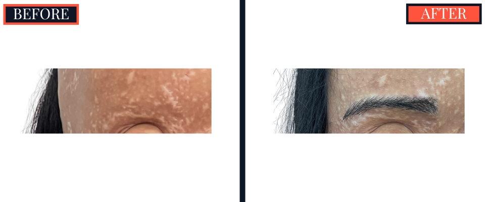 FUT EYEBROW TRANSPLANT
