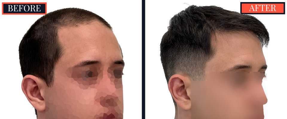 3008 GRAFT FUE HAIR TRANSPLANT BEFORE AND AFTER RESULT