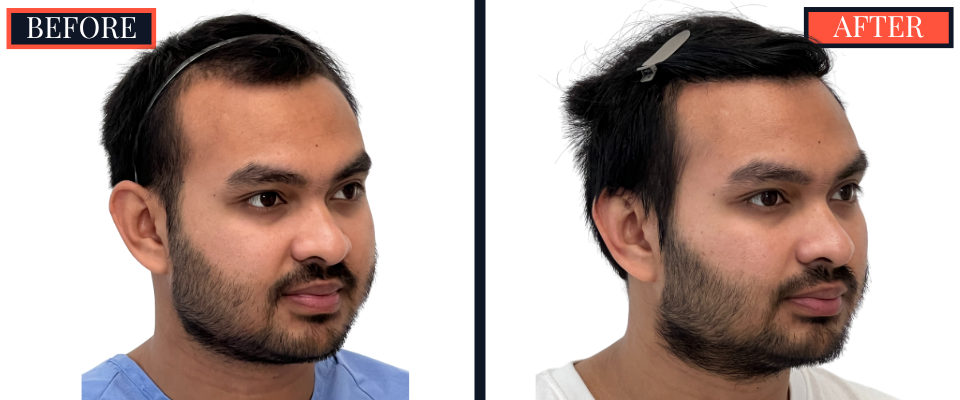 1006 GRAFT FUE HAIR TRANSPLANT - 1 YR POST-OP RESULT