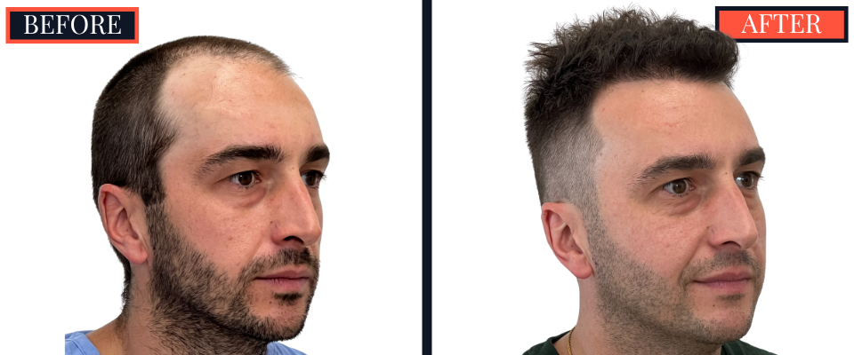 2206 graft FUE HAIR TRANSPLANT - 1 year Post-Op Results