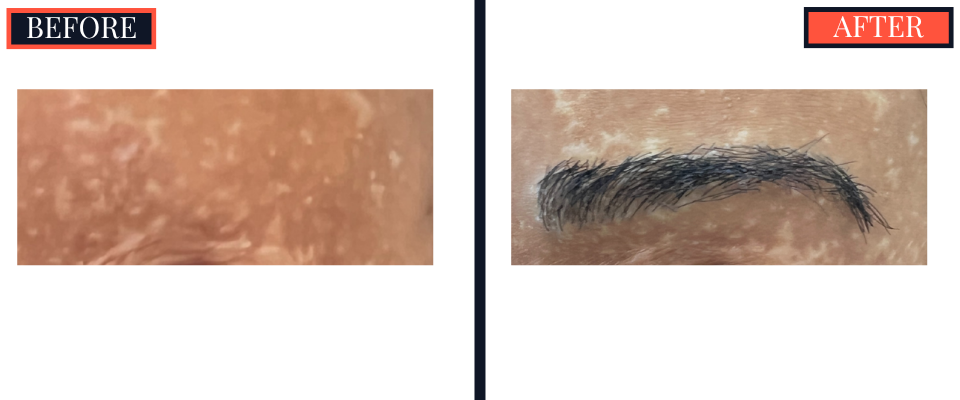 FUT EYEBROW TRANSPLANT