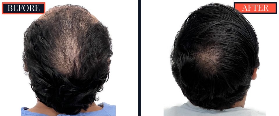2344 GRAFT FUE BEFORE AND AFTER RESULTS