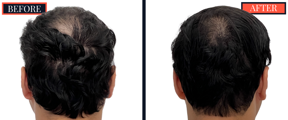 2344 GRAFT FUE BEFORE AND AFTER RESULTS