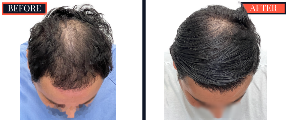 2344 GRAFT FUE BEFORE AND AFTER RESULTS